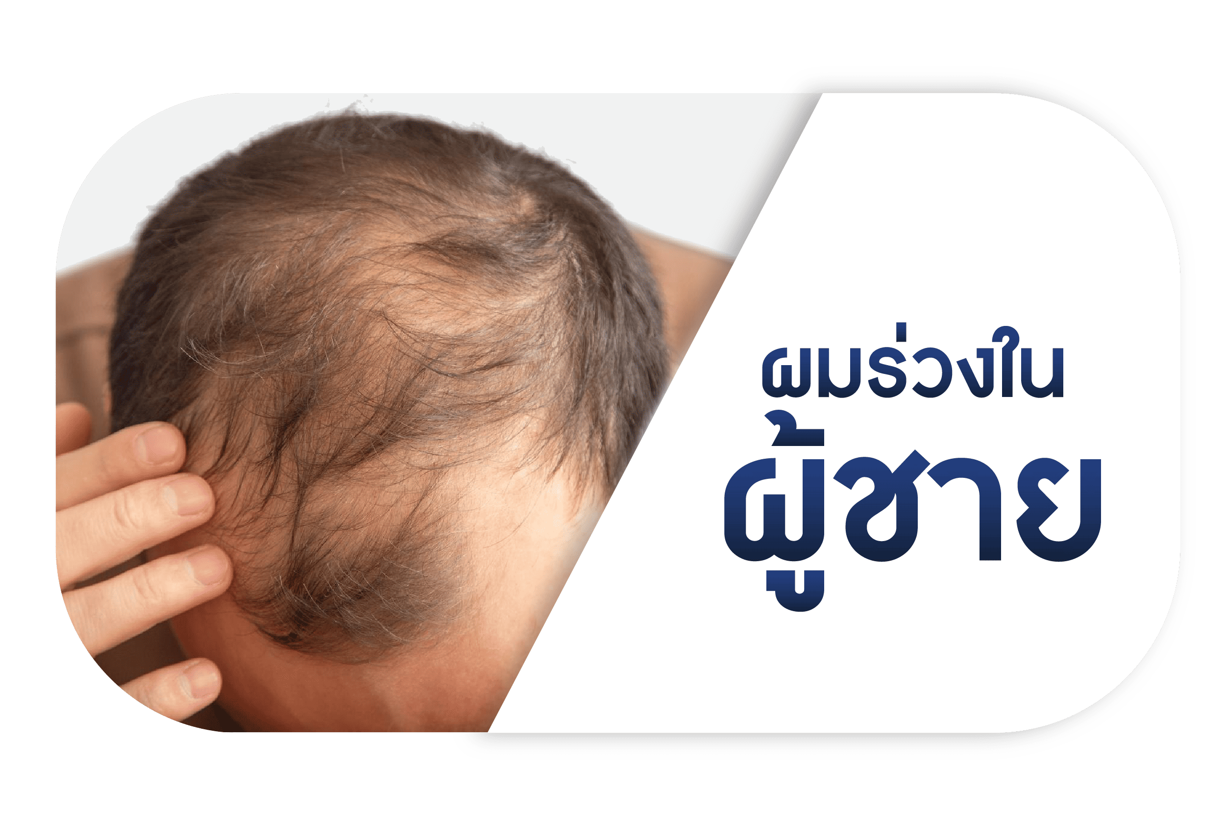 ผมร่วงในผู้ชาย