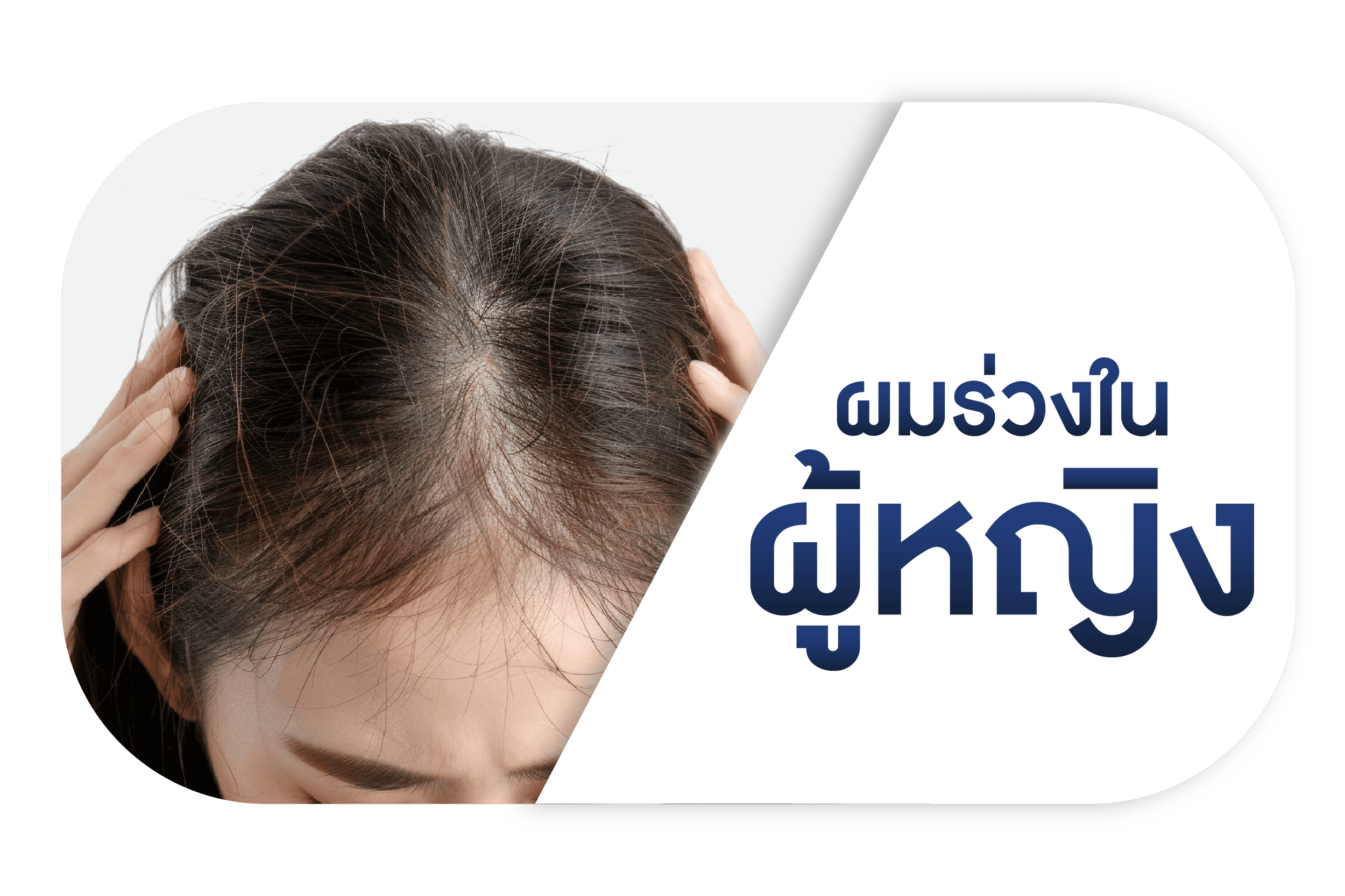 ผมร่วงในผู้หญิง