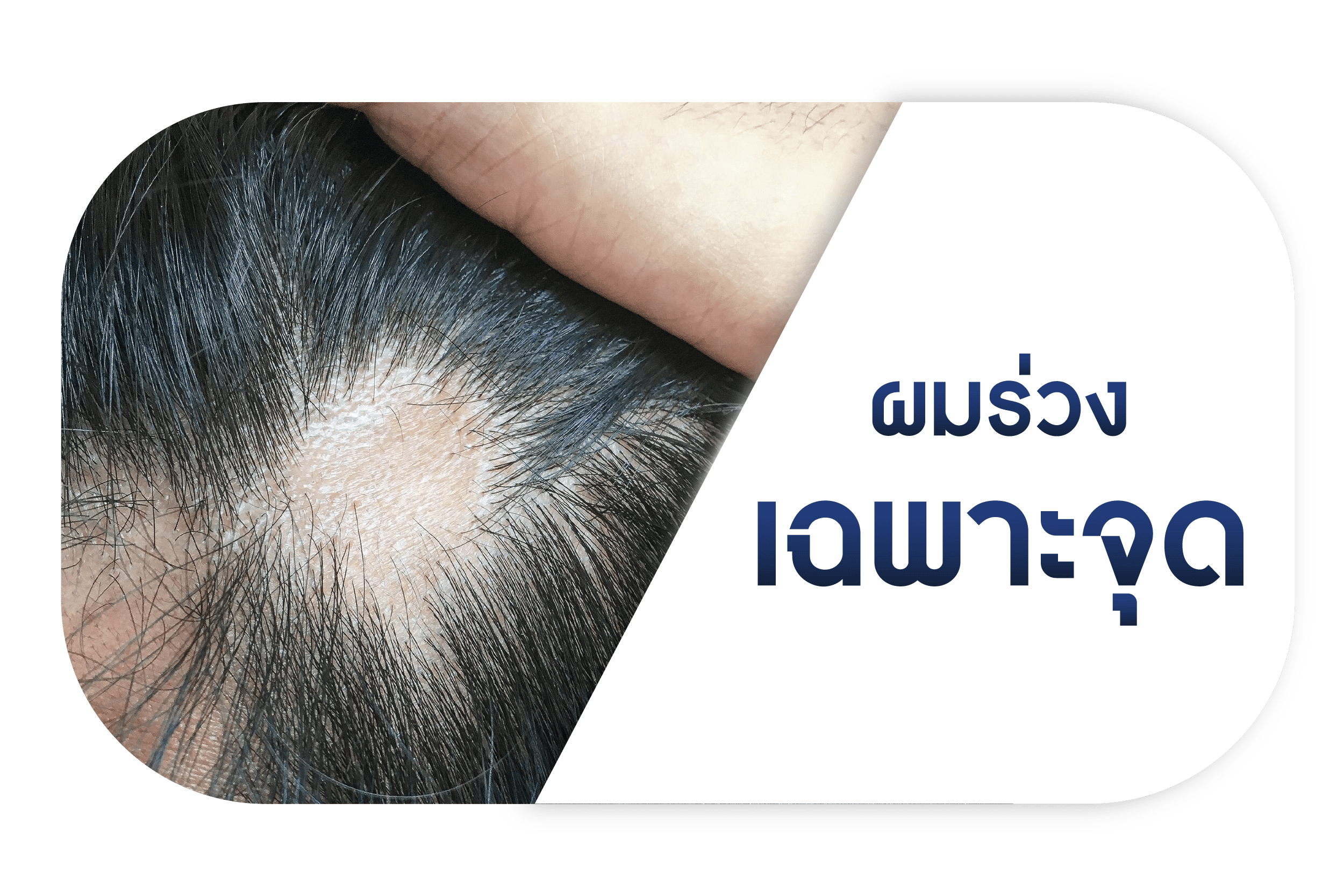 ผมร่วงเฉพาะจุด
