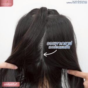 รอยแผลปลูกผม