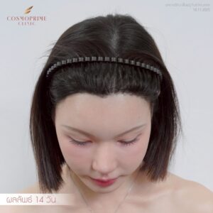 ผลลัพธ์ปลูกผมแบบ Long Hair