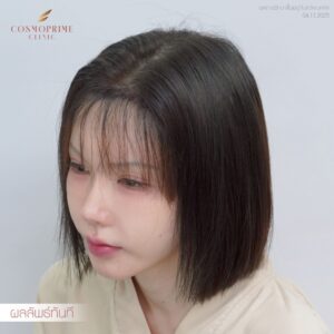 ปลูกผมแบบ Long Hair