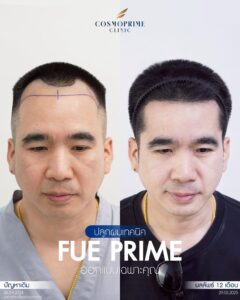 รปลูกผม FUE ด้วยการย้ายกราฟผมทีละหน่วย