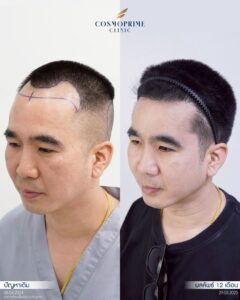 คุณภาพบริเวณ donor ที่ใช้ในการปลูกผม FUE