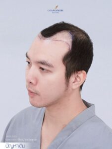 ผลลัพธ์การปลูกผม FUE