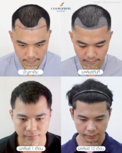 การเปลี่ยนแปลงของเส้นผมหลังปลูกผม DHI