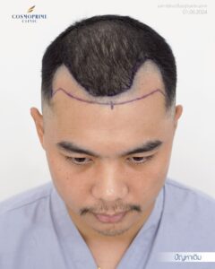 เส้นผมก่อนปลูกผม DHI
