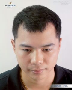 เส้นผมหลังปลูกผม DHI 3 เดือน