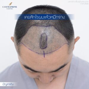 ผมก่อนปลูกมีรอยสักจางๆ