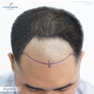 แนวผมใหม่หลังปลูกผม DHI