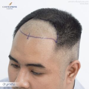 การออกแบบแนวผมด้วยเทคนิคปลูกผม DHI