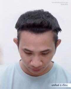 ภาพก่อนและหลังการปลูกผมด้วยเทคนิค DHI เห็นแนวผมชัดเจนขึ้น 8 เดือน