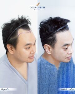 ภาพก่อนและหลังการปลูกผมด้วยเทคนิค FUE เห็นความหนาแน่นของเส้นผมเพิ่มขึ้น