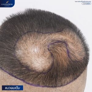 ภาพก่อนและหลังการปลูกผมกลางศีรษะ