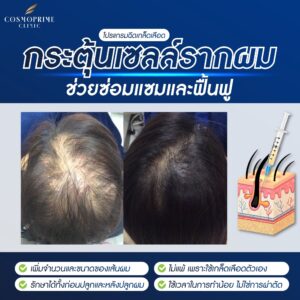 การทำ PRP กระตุ้นรากผมเพื่อฟื้นฟูเส้นผม