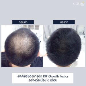 ขั้นตอนการฉีด PRP กระตุ้นรากผม