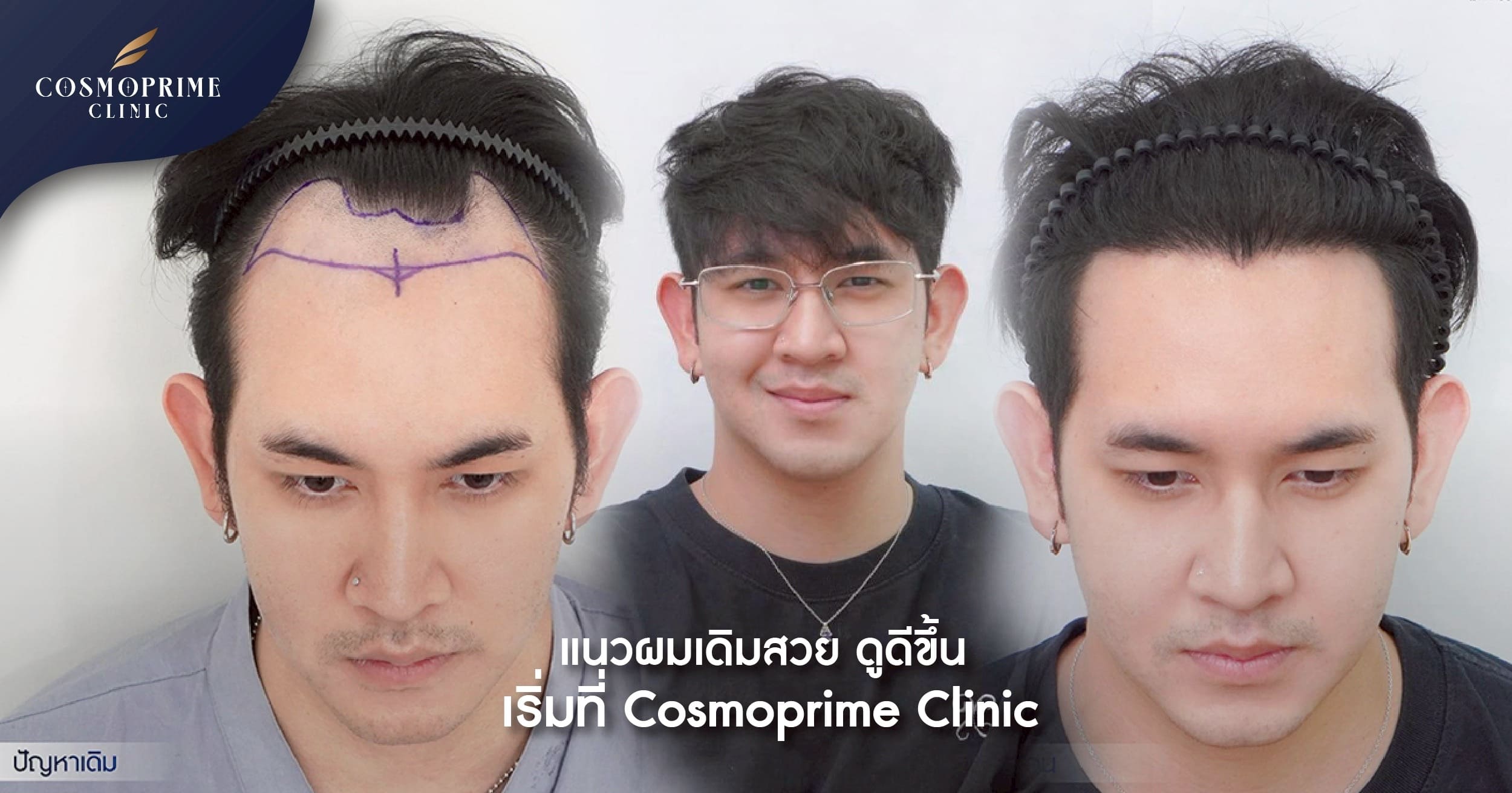 แนวผมเดิมสวย