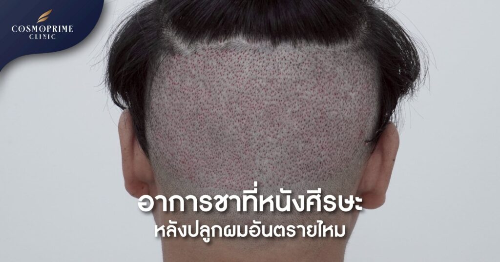 อาการชาที่หนังศีรษะหลังปลูกผม