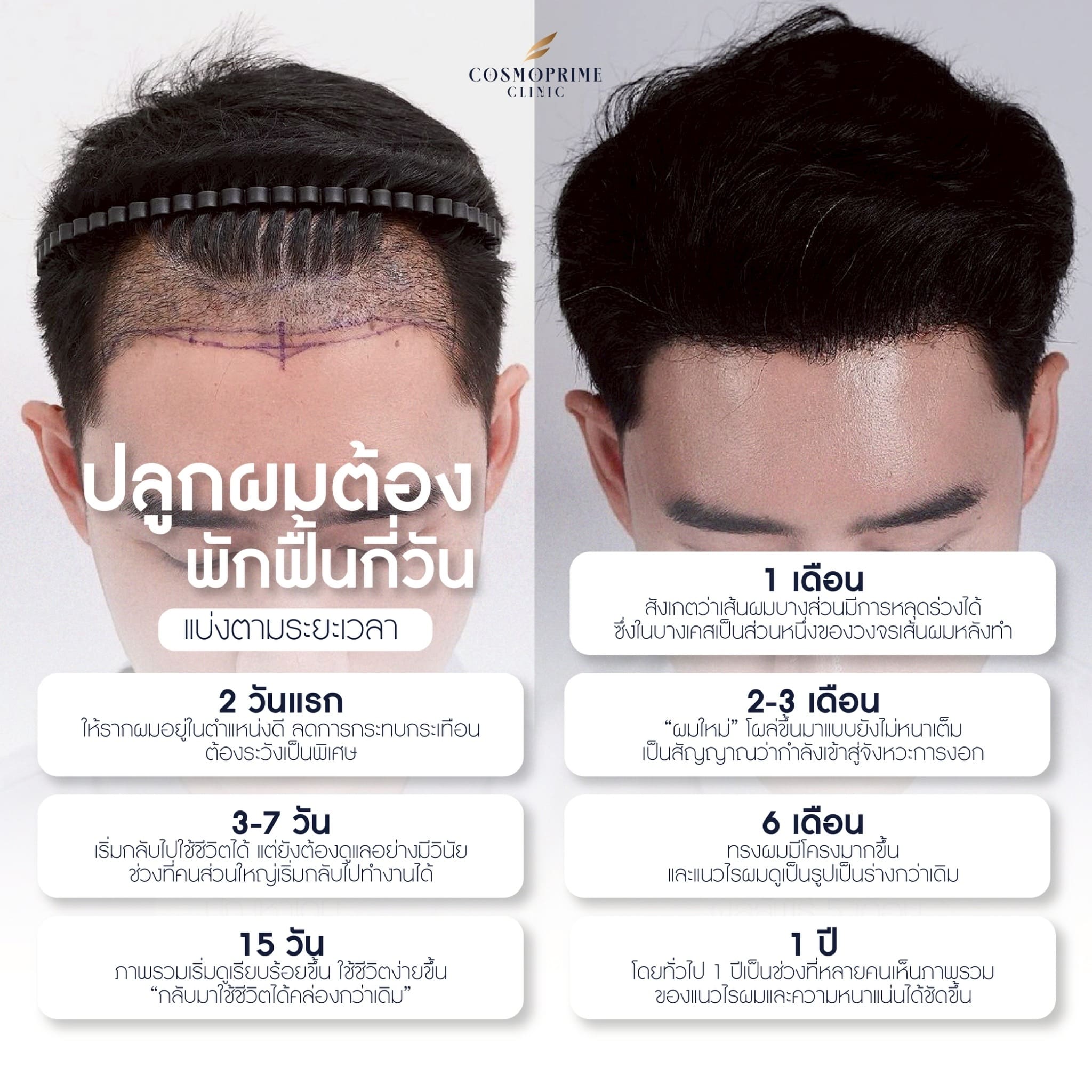 ปลูกผม ต้องพักฟื้นกี่วัน แบ่งตามระยะเวลา