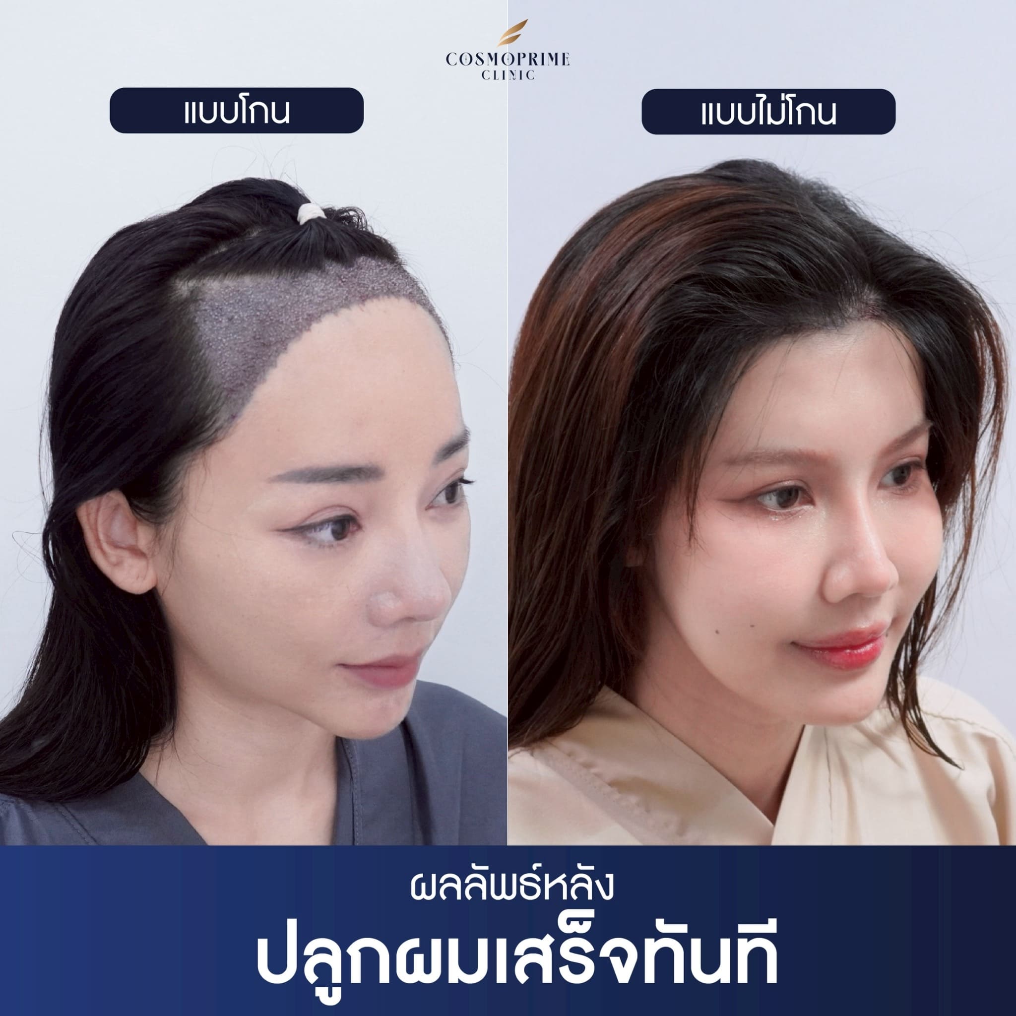 ปลูกผมแบบโกนหัว กับแบบไม่ต้องโกน ต่างกันยังไง