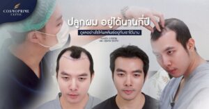 ปลูกผม อยู่ได้นานกี่ปี