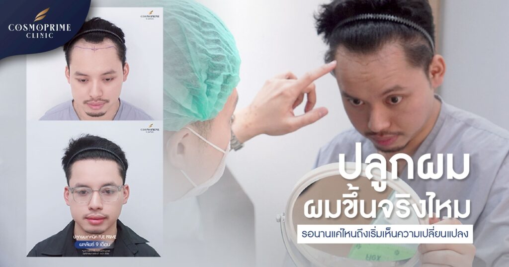 ปลูกผมแล้วผมขึ้นจริงไหม