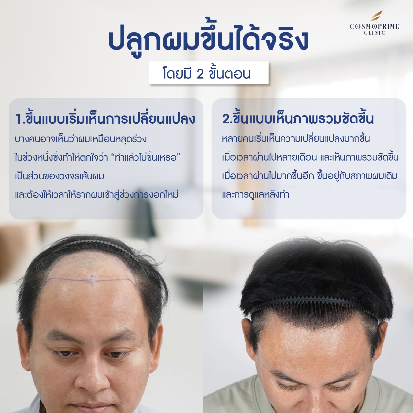 ผมขึ้นหลังปลูกผมได้จริง