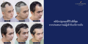 คลินิกปลูกผมที่รีวิวดีที่สุด จากประสบการณ์ผู้เข้ารับบริการจริง