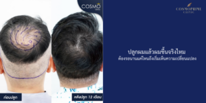 ปลูกผมแล้วผมขึ้นจริงไหม