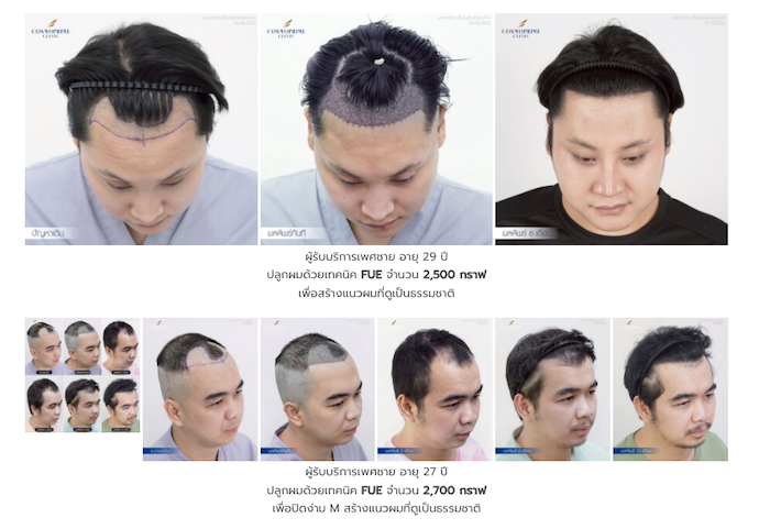 รีวิวปลูกผม Cosmoprime Clinic